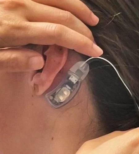 IB-Stim wearable device fits behind the ear and sends electrical impulses to nerve bundles